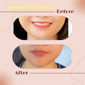 LINE_ALBUM_Review Botox_230817_1