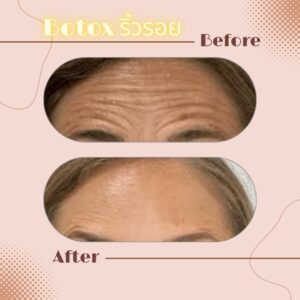 LINE_ALBUM_Review Botox_230817_11