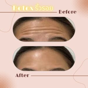 LINE_ALBUM_Review Botox_230817_13