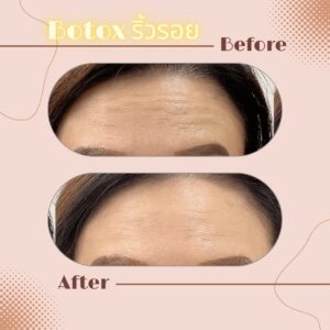 LINE_ALBUM_Review Botox_230817_14