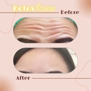 LINE_ALBUM_Review Botox_230817_16