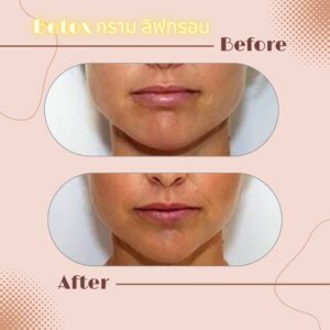 LINE_ALBUM_Review Botox_230817_2