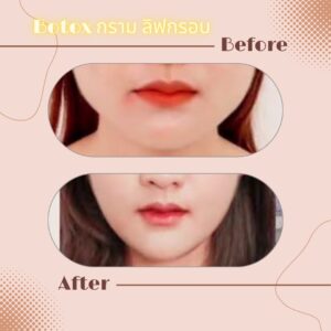 LINE_ALBUM_Review Botox_230817_5