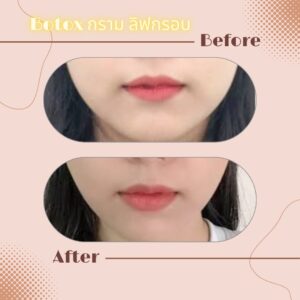 LINE_ALBUM_Review Botox_230817_6