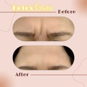 LINE_ALBUM_Review Botox_230817_7
