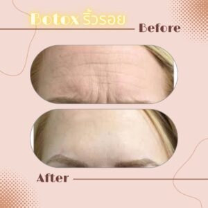 LINE_ALBUM_Review Botox_230817_9