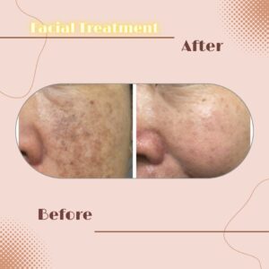 LINE_ALBUM_Review Facial Treatment_230817_7