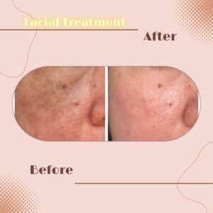 LINE_ALBUM_Review Facial Treatment_230817_8