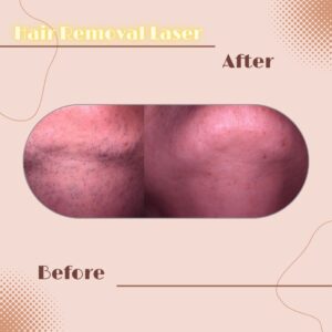 LINE_ALBUM_Review HAIR REMOVAL LASER_230817_10