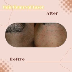 LINE_ALBUM_Review HAIR REMOVAL LASER_230817_11