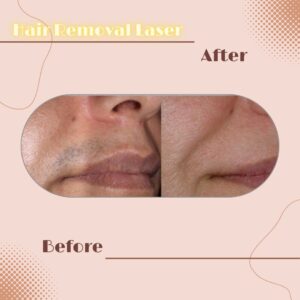 LINE_ALBUM_Review HAIR REMOVAL LASER_230817_12