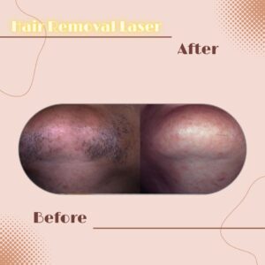 LINE_ALBUM_Review HAIR REMOVAL LASER_230817_13