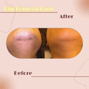 LINE_ALBUM_Review HAIR REMOVAL LASER_230817_14