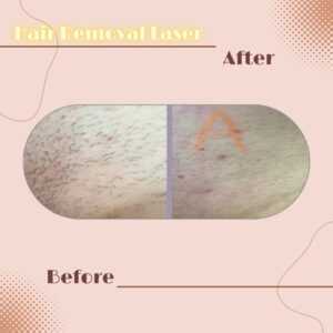 LINE_ALBUM_Review HAIR REMOVAL LASER_230817_2