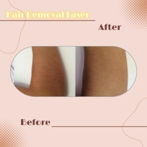 LINE_ALBUM_Review HAIR REMOVAL LASER_230817_3