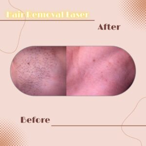 LINE_ALBUM_Review HAIR REMOVAL LASER_230817_4
