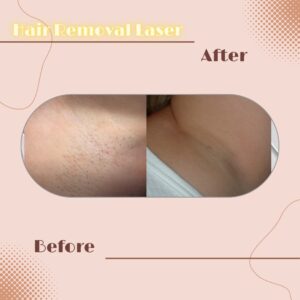 LINE_ALBUM_Review HAIR REMOVAL LASER_230817_6