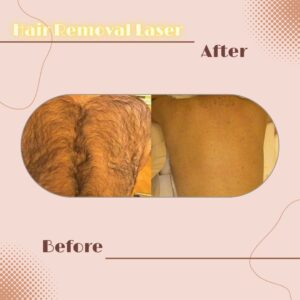 LINE_ALBUM_Review HAIR REMOVAL LASER_230817_7