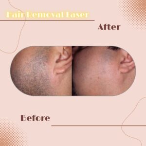 LINE_ALBUM_Review HAIR REMOVAL LASER_230817_8
