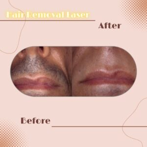 LINE_ALBUM_Review HAIR REMOVAL LASER_230817_9