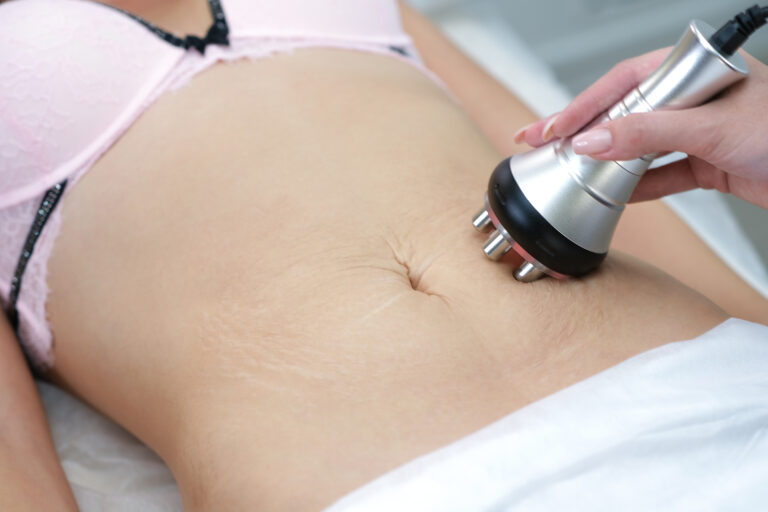 stretch marks on the skin after childbirth and weight loss. RF lifting hardware massage on the belly of a young woman. Cellulite solution and weight loss