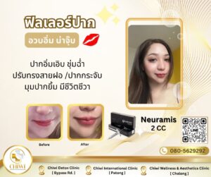 ฟิลเลอร์ 1 CC เติมตรงไหนได้บ้าง? ปริมาณน้อยนิดที่เปลี่ยนคุณให้สวยปัง!